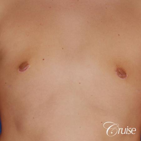 teen with pointy / puffy nipples get gynecomastia surgery - Before and After Image 4