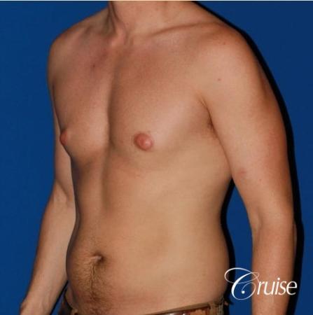 puffy nipple on low body fat - Before Image 3