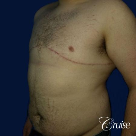 male breast reduction surgery orange county - After 3