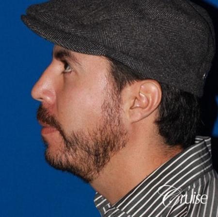 male patient with large chin augmentation - After Image 2