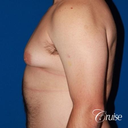 20 with Gynecomastia and puffy nipple - Before and After Image 2