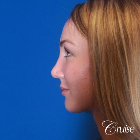 best rhinoplasty with natural results - After Image 3