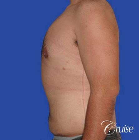 male liposuction abdomen flanks with Gynecomastia - After Image 4