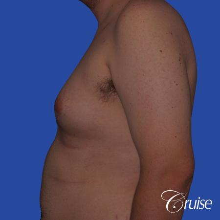 moderate gyne on young male adult - Before Image 2