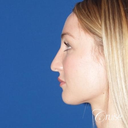 best rhinoplasty with natural results - Before Image 3