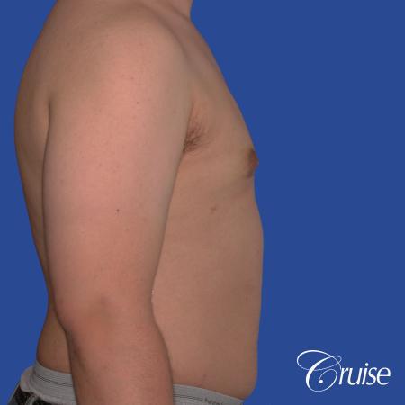 best scars for moderate gynecomastia - After Image 3