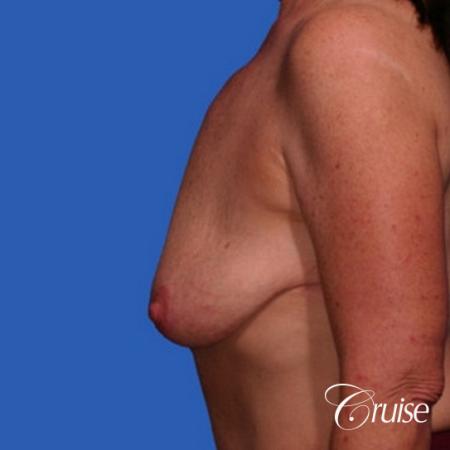 best breast lift anchor with saline augmentation - Before and After Image 2