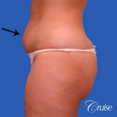 best liposuction abdomen flanks medial and lateral thighs dramatic - Before Image 2