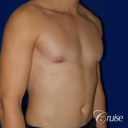 Mild Gynecomastia -Areola Incision - After Image 4