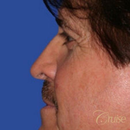 male has brow lift with face lift - Before 2