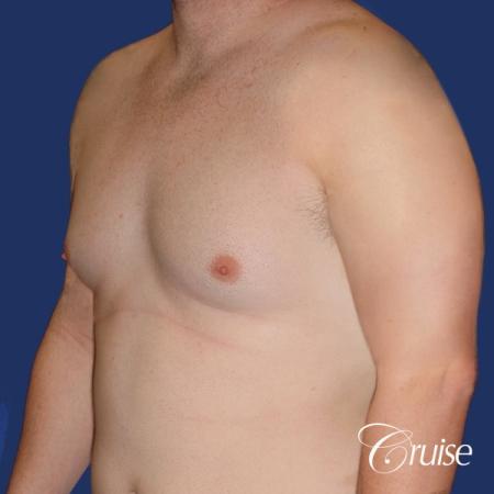 moderate chest gynecomastia and liposuction flanks - Before and After Image 2