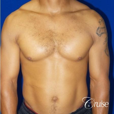 gynecomastia caused by testosterone - Before 1