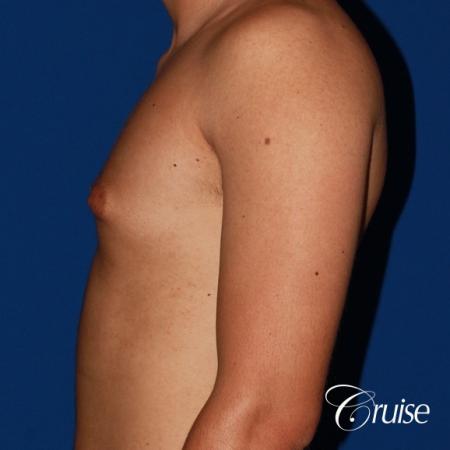 mild gynecomastia before and after with puffy nipple - Before Image 2