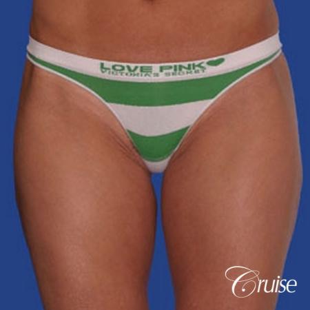 best thigh thinning liposuction on thighs - After Image 2