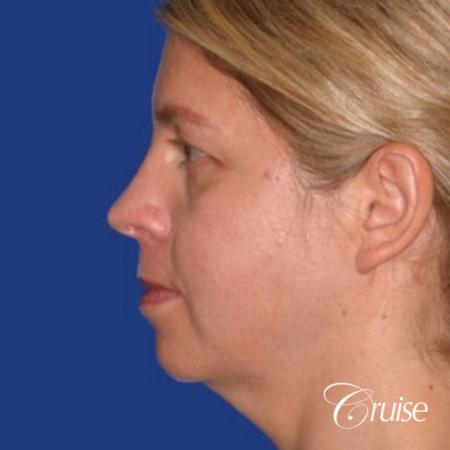 female who got large chin implant in Newport Beach - Before and After Image 2