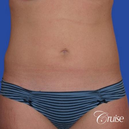 best skinny abs from liposuction abdomen and flanks - After Image 1