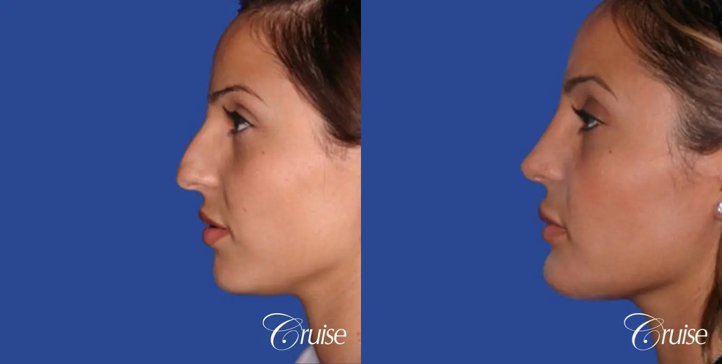 Rhinoplasty: Dorsal Hump Reduction - Before and After 2