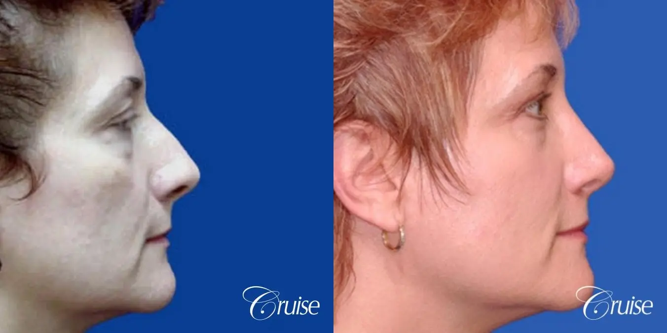 Rhinoplasty: Deviated Septum Correction  - Before and After 3