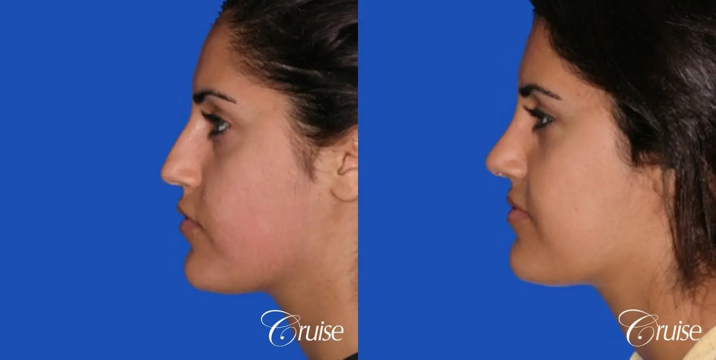 Rhinoplasty: Dorsal Hump Reduction - Before and After 2