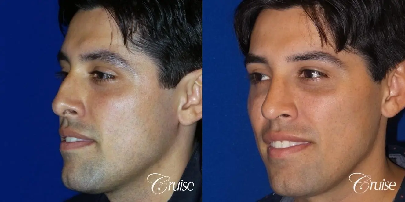 Rhinoplasty: Patient 64 - Before and After 3