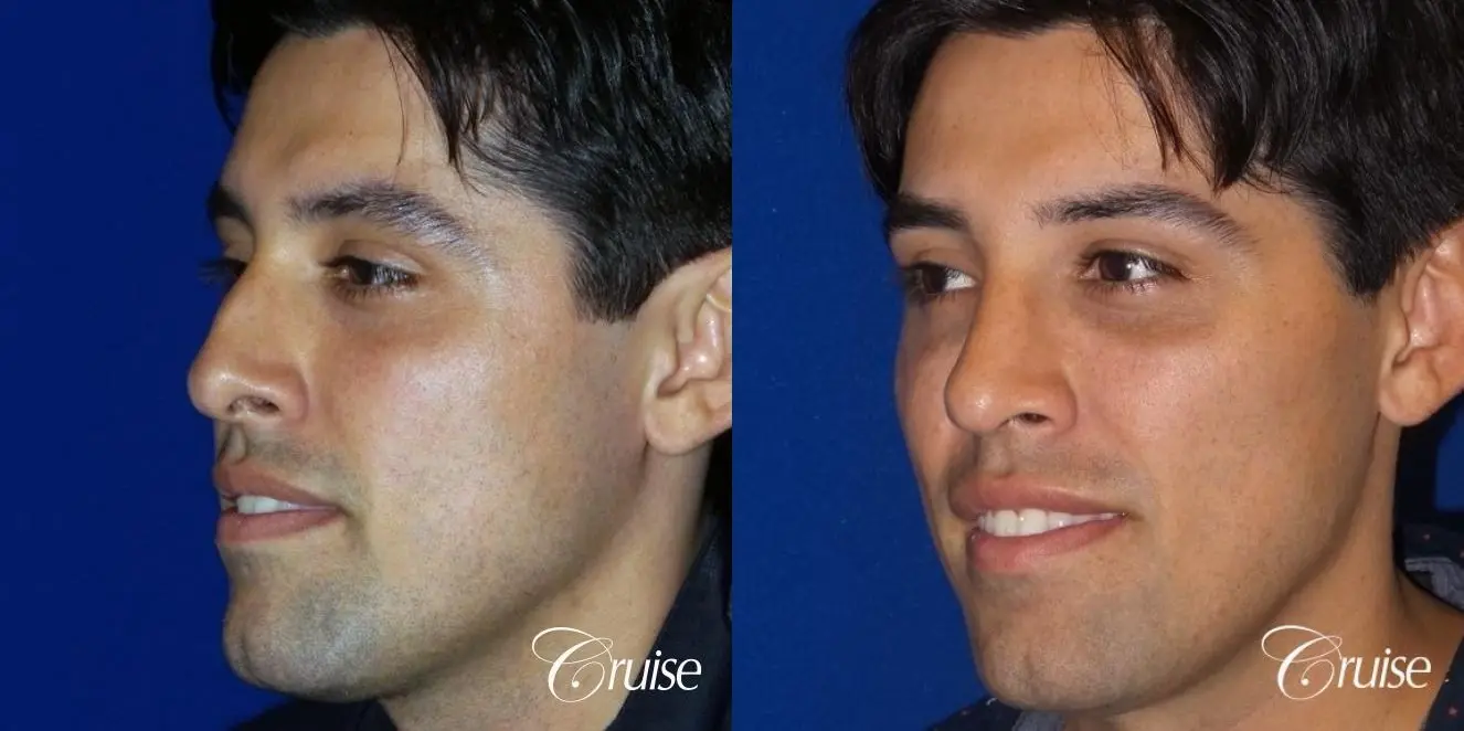 Rhinoplasty: Patient 67 - Before and After 3