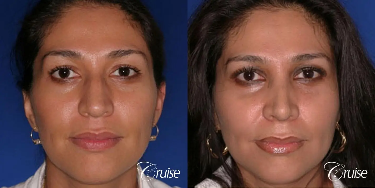 Rhinoplasty: Bridge Narrowing & Hump Reduction  - Before and After 1