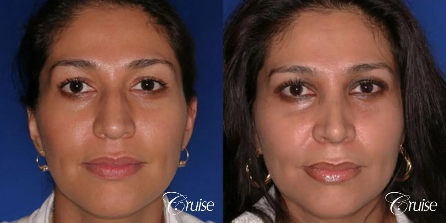 Rhinoplasty: Bridge Narrowing & Hump Reduction - Before and After 1