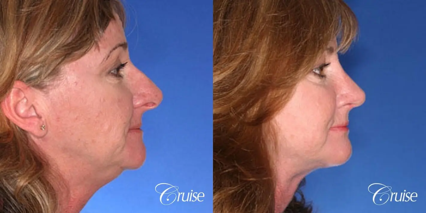 Rhinoplasty w/ Mini Neck Lift - Before and After 4