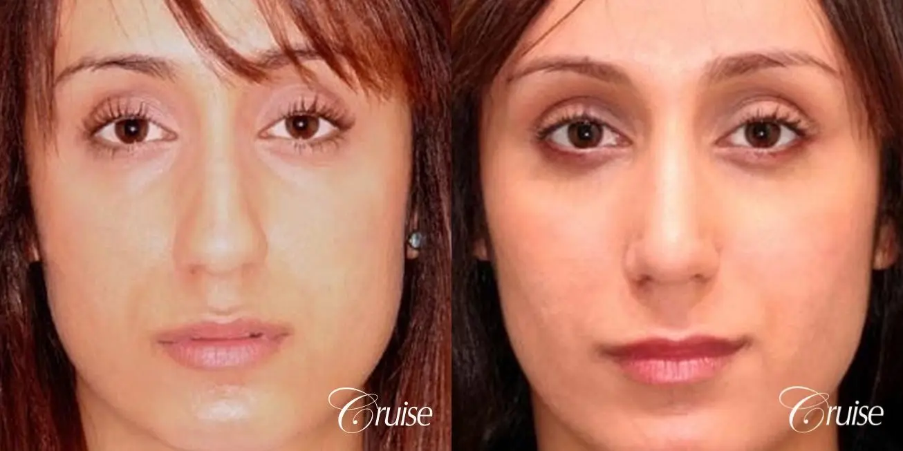 Rhinoplasty: Dorsal Hump Correction  - Before and After 1