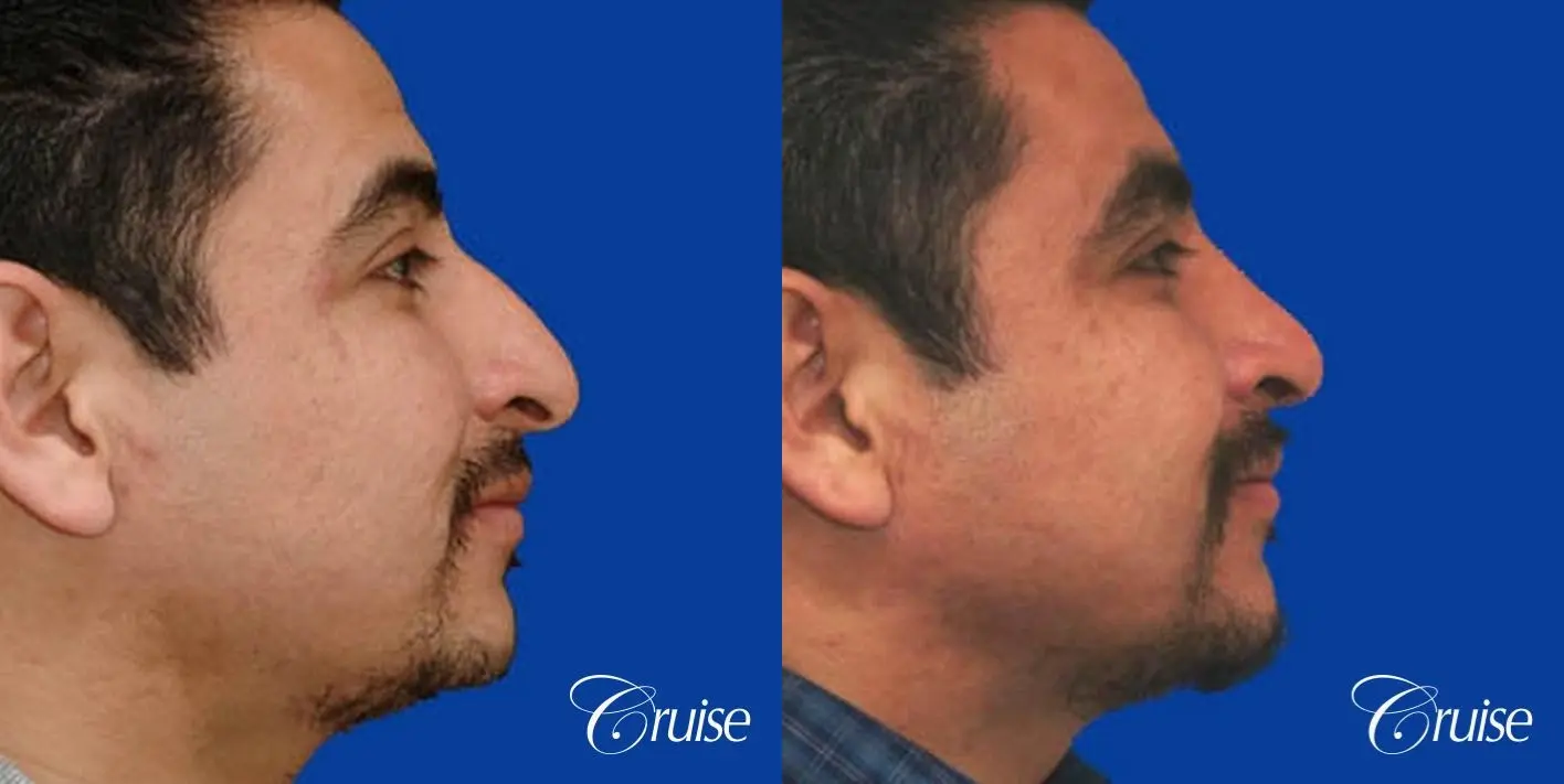 Rhinoplasty: Dorsal Hump, Droopy Tip Correction, Nose Shortening - Before and After 1