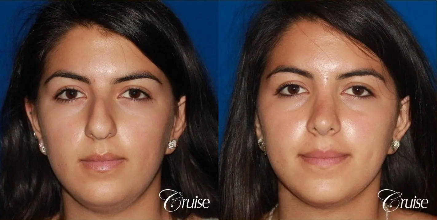 Rhinoplasty: Dorsal Hump & Droopy Tip Correction - Before and After 1