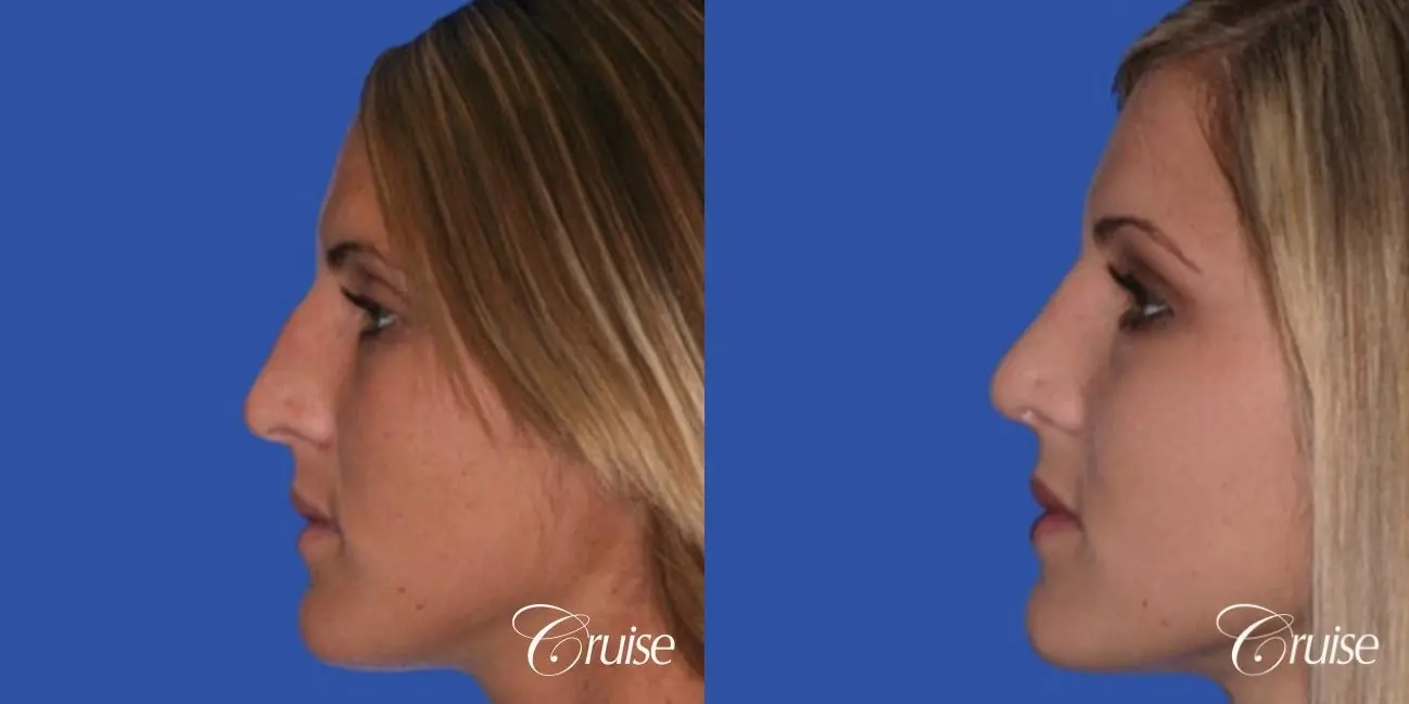 Rhinoplasty: Hump Reduction & Tip Narrowing  - Before and After 2