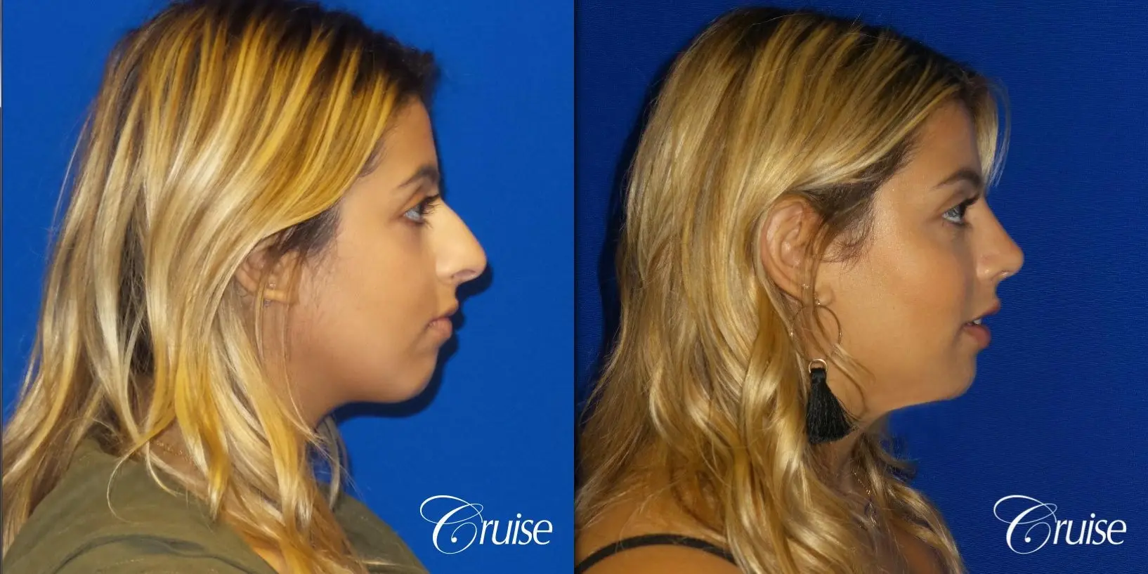 Rhinoplasty: Dorsal Hump & Droopy Tip Correction - Before and After 3