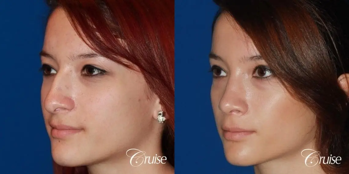 Rhinoplasty: Dorsal Hump Reduction  - Before and After 2