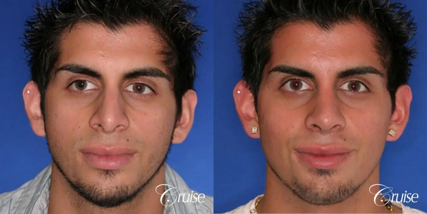 Rhinoplasty: Tip Refinement  - Before and After 1