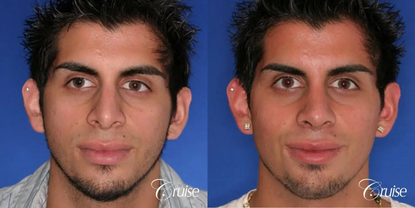 Rhinoplasty: Tip Refinement - Before and After 1