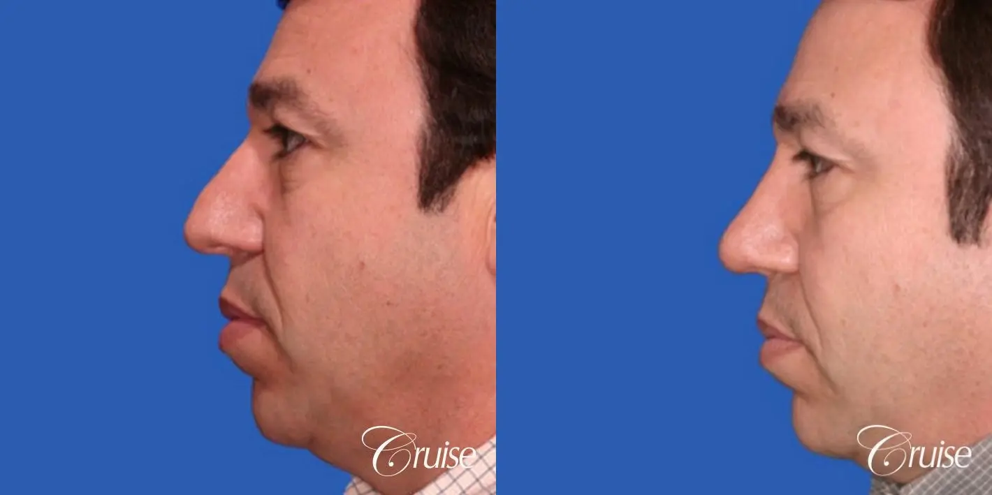 Rhinoplasty: Dorsal Hump Correction   - Before and After 1