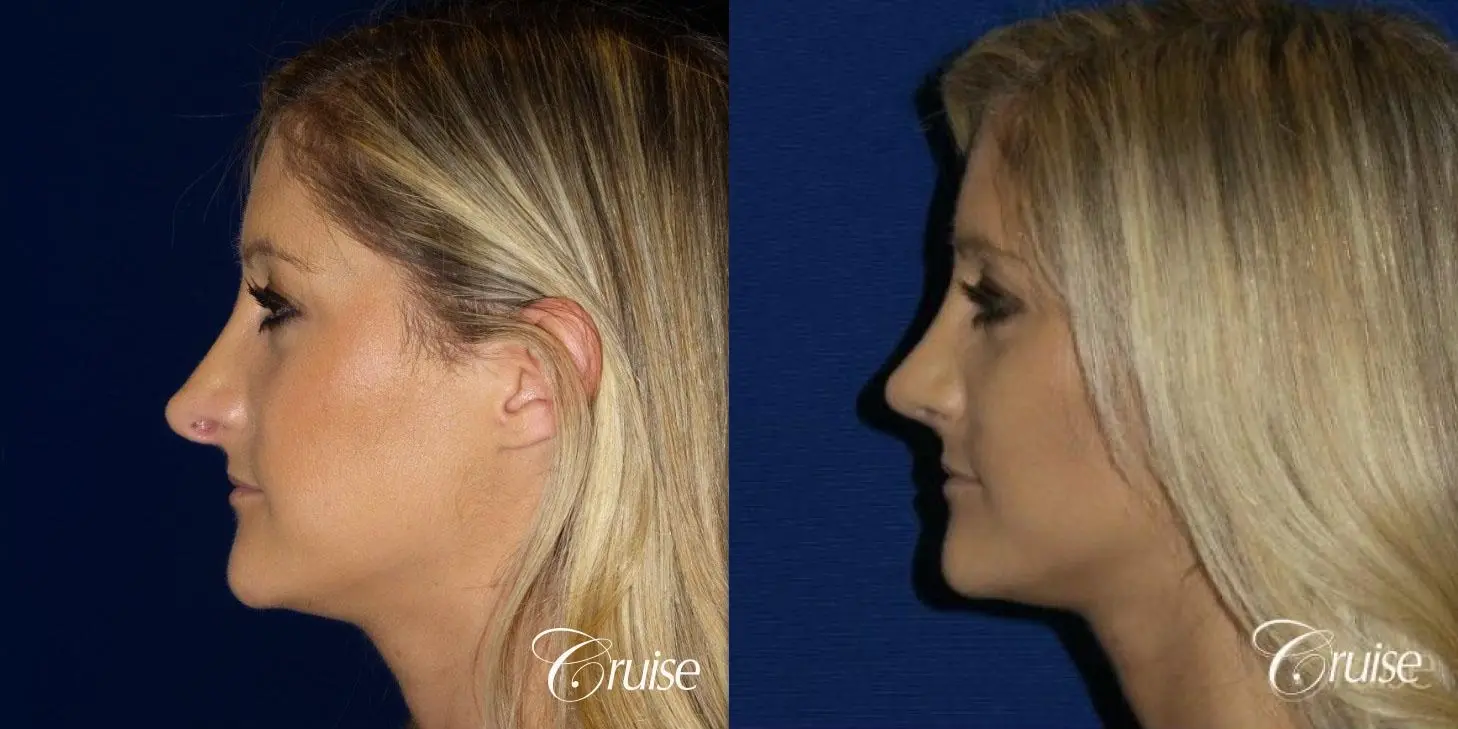 Best Rhinoplasty results Newport Beach CA - Before and After 4