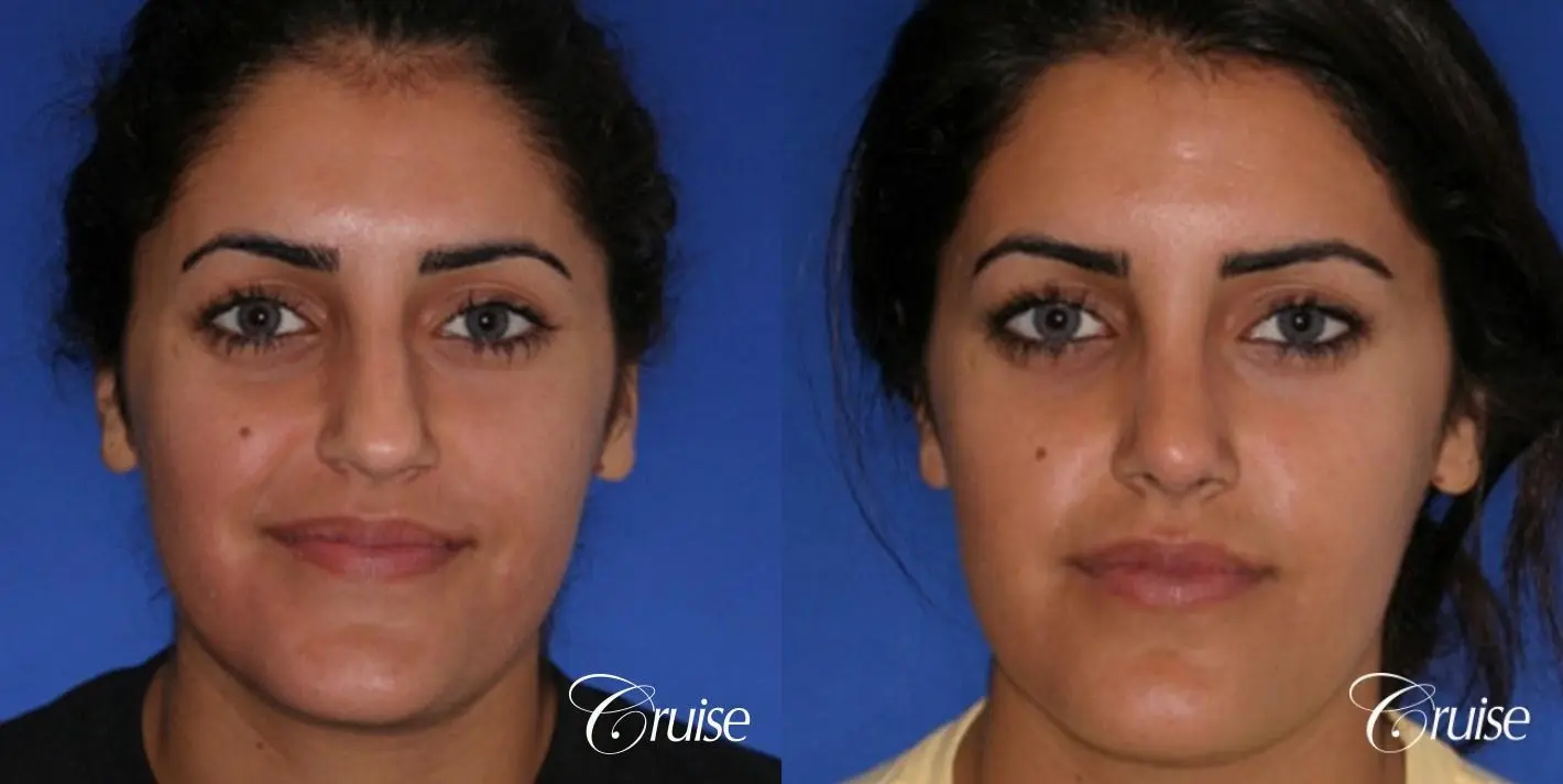 Rhinoplasty: Dorsal Hump Reduction - Before and After 1
