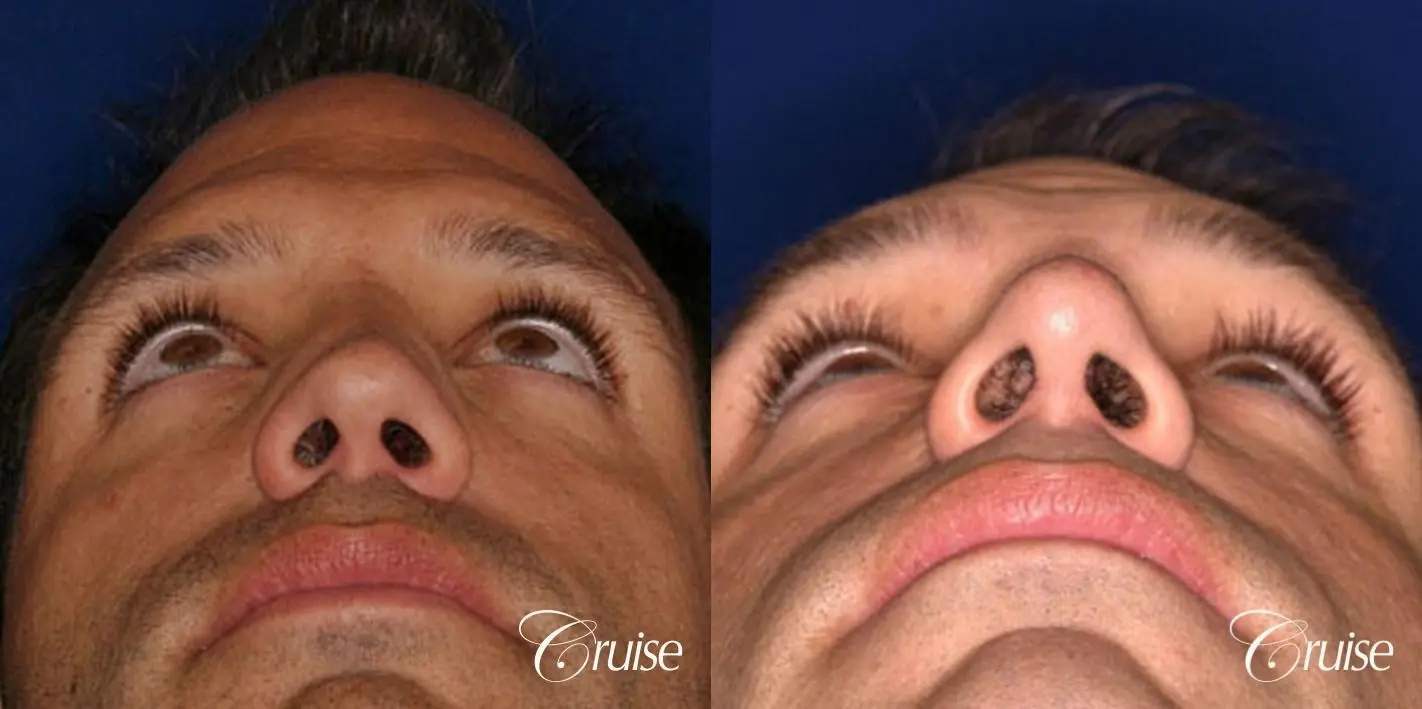 Rhinoplasty Revision: Correction of Ski Sope Deformity, Loss of Dorsal Lines - Before and After 3