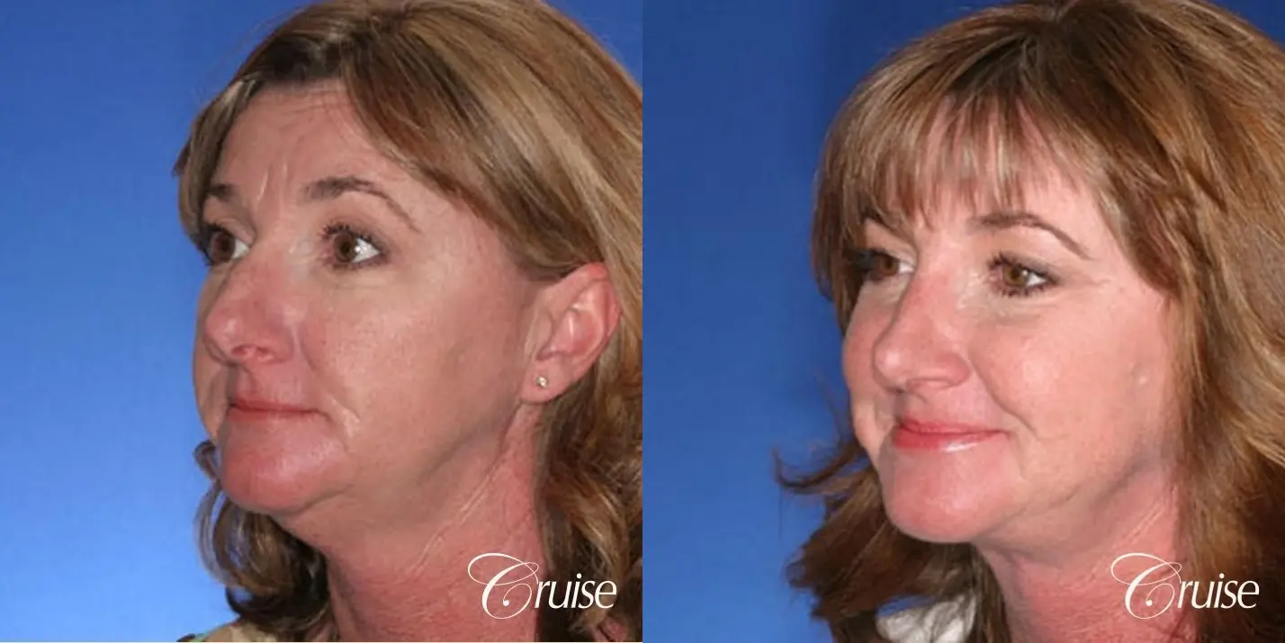 Rhinoplasty w/ Mini Neck Lift - Before and After 2