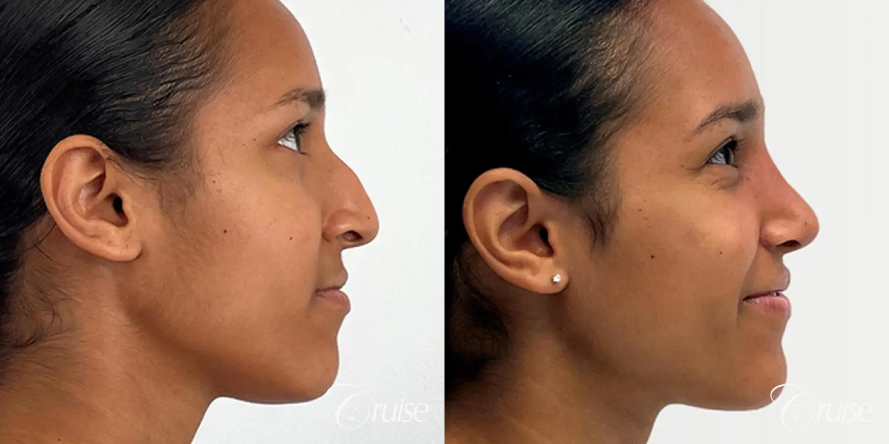 Open Ethnic Rhinoplasty - Before and After 4