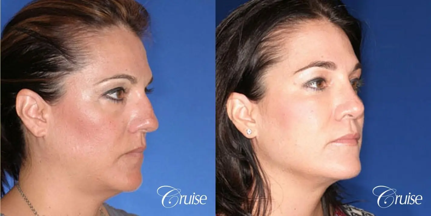Rhinoplasty: Hump Reduction & Droopy Tip Correction  - Before and After 3