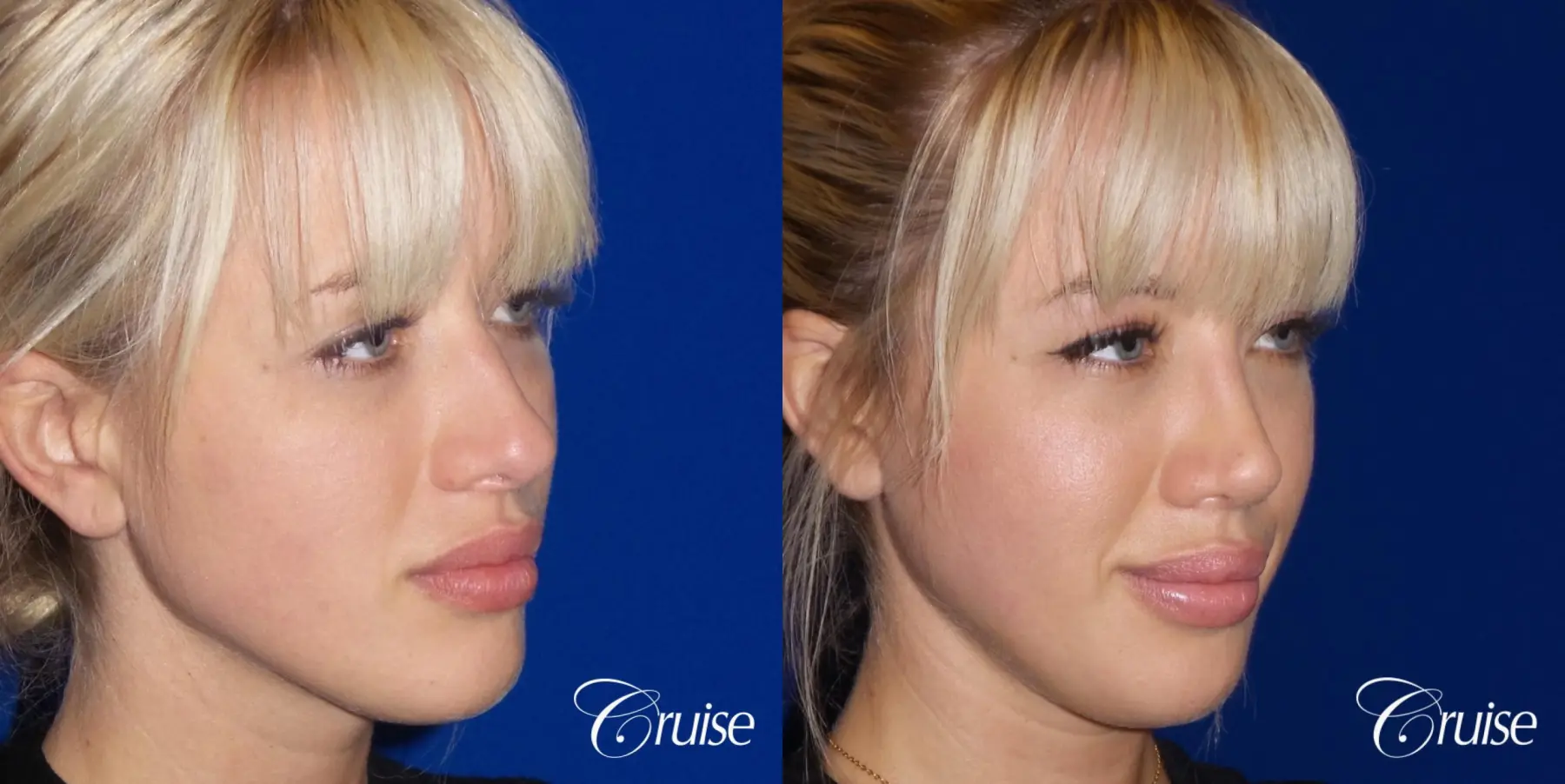 Rhinoplasty: Patient 63 - Before and After 2