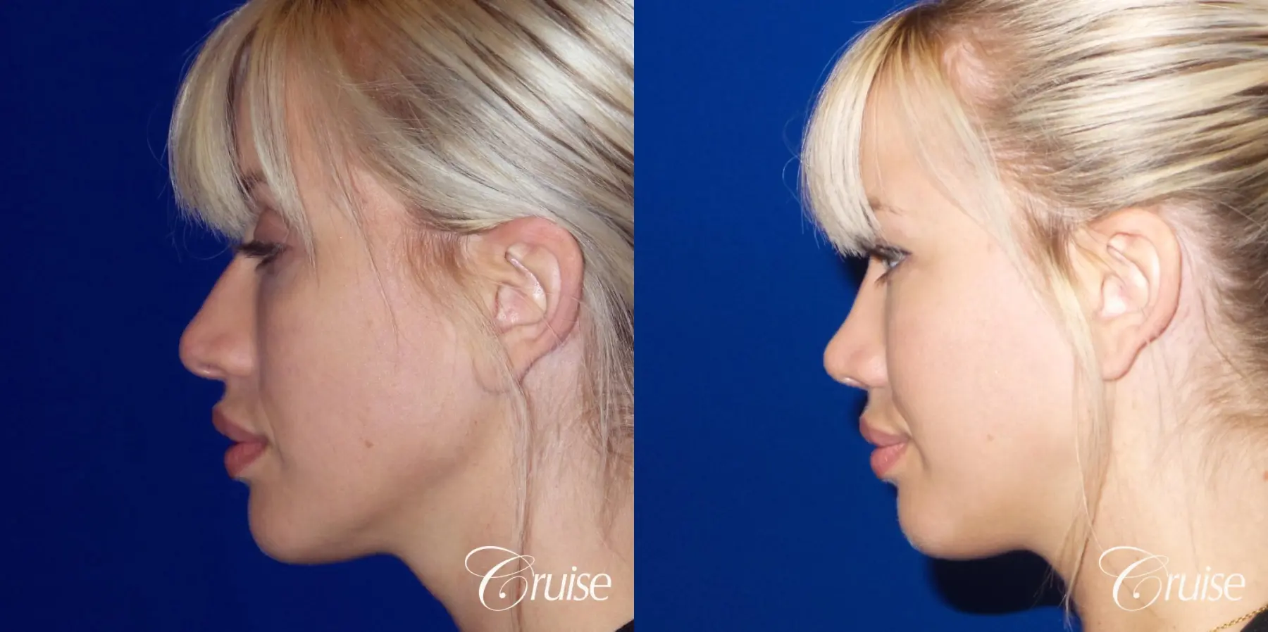 Rhinoplasty: Patient 63 - Before and After 4