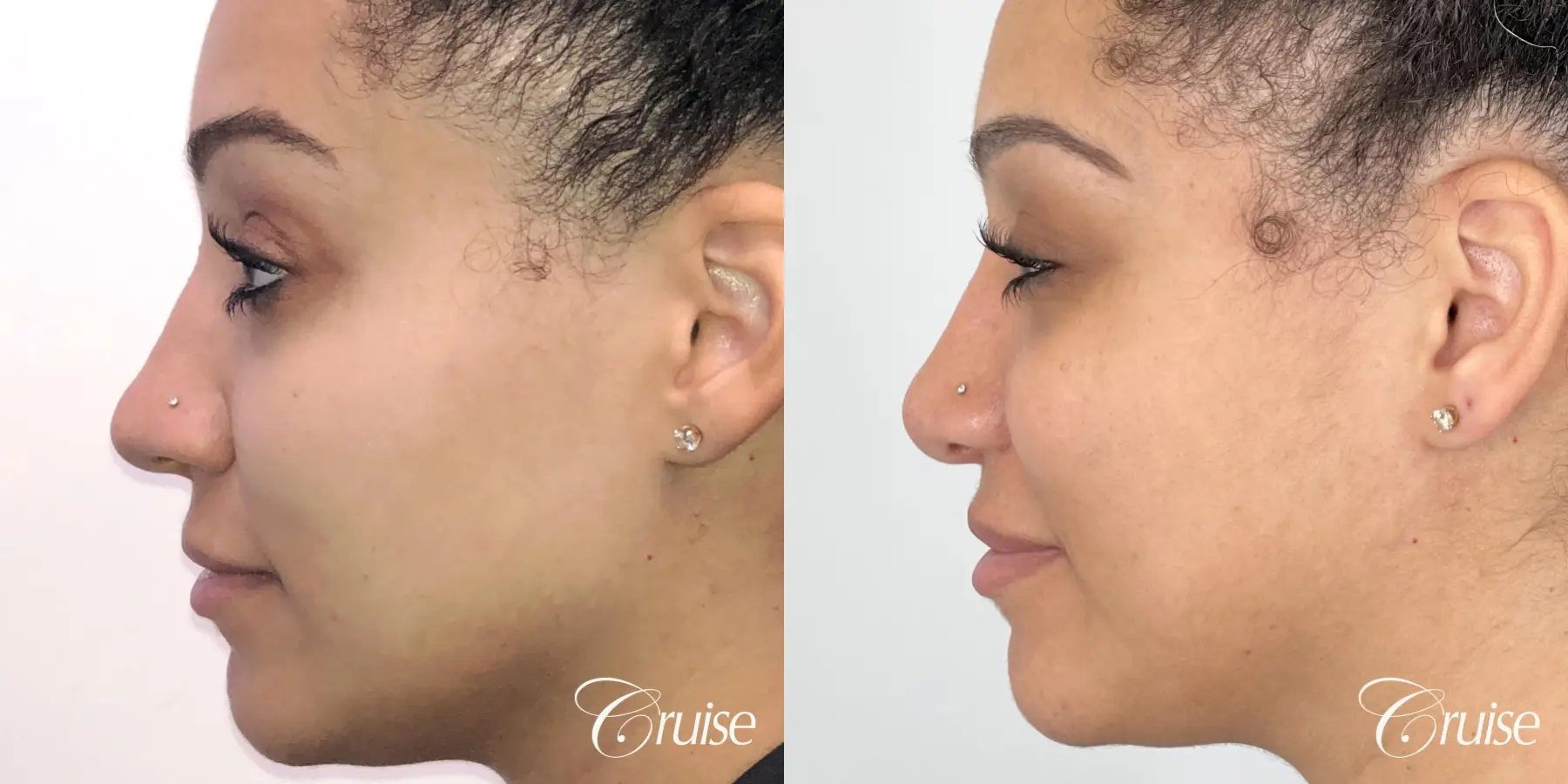 rhinoplasty orange county - Before and After 3