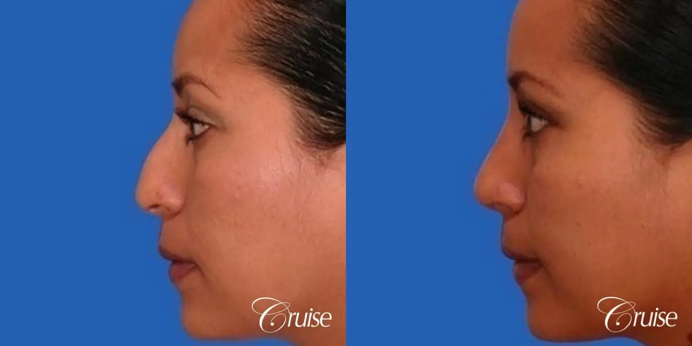 Rhinoplasty: Hump Reduction - Before and After 2