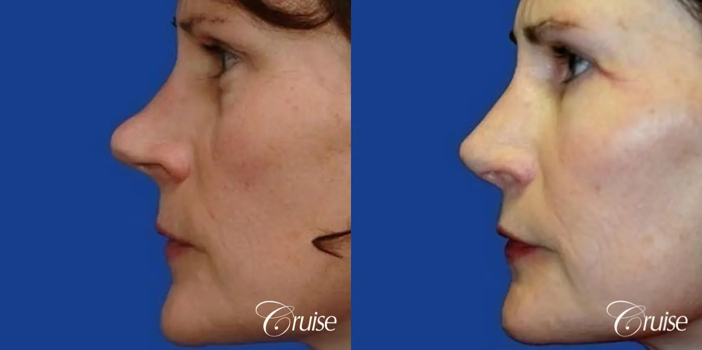 Rhinoplasty: De-Projection of the Nose  - Before and After 2