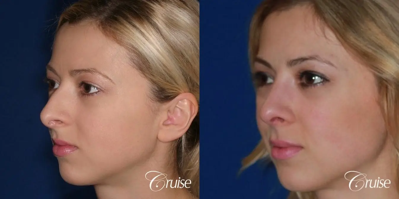 Rhinoplasty: Dorsal Hump Reduction  - Before and After 2