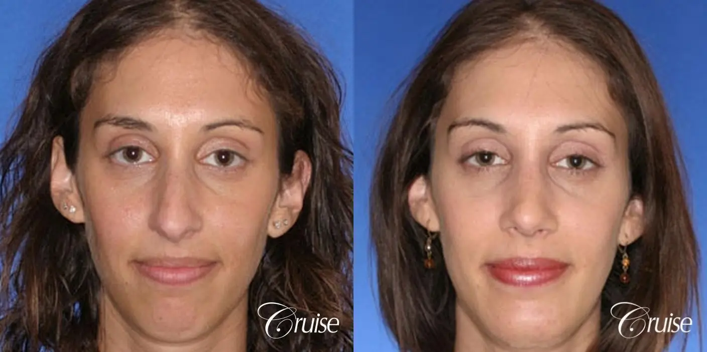 Rhinoplasty w/ Chin Augmentation  - Before and After 1